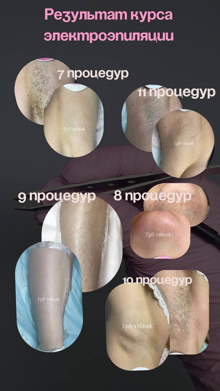 Фото 2: Частный мастер с медицинским образованием и 8-летним стажем проводит электроэпиляцию